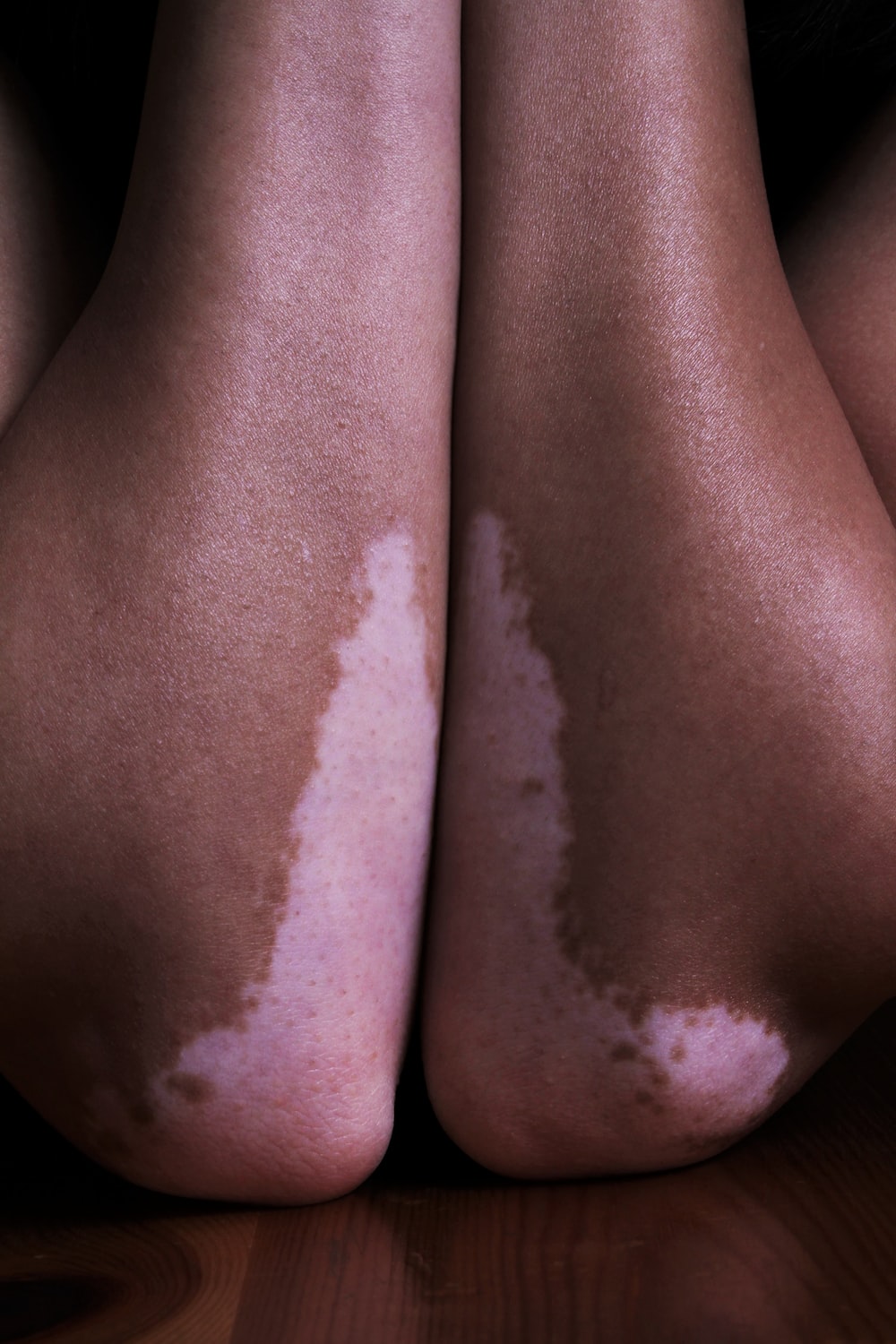 a close up of a person's legs with white spots on them
