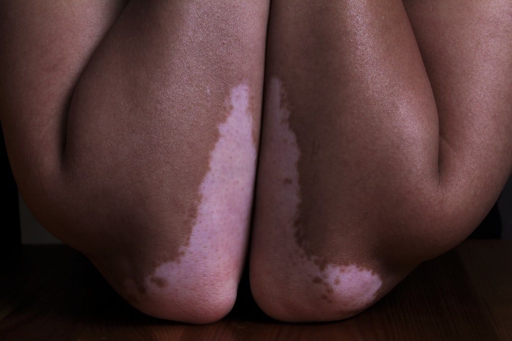 a person with white spots on their legs